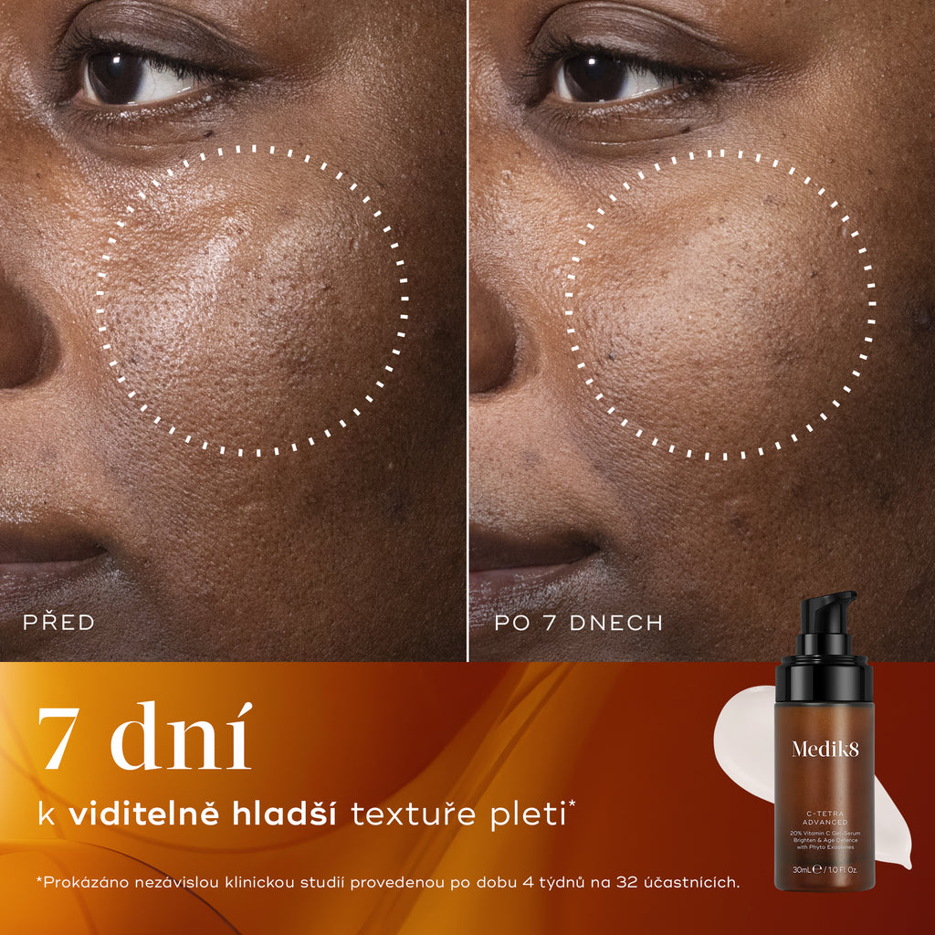 Detailní záběr tváře osoby, na kterém je patrná nerovnoměrná struktura pokožky a viditelné póry před použitím přípravku C-Tetra Advanced; problémová oblast je vyznačena tečkovaným kruhem.   Detailní záběr téže tváře po 7 dnech používání přípravku C-Tetra Advanced, na kterém je patrně viditelná hladší struktura pleti a zúžené póry; pro srovnání je vyznačen tečkovaný kruh.