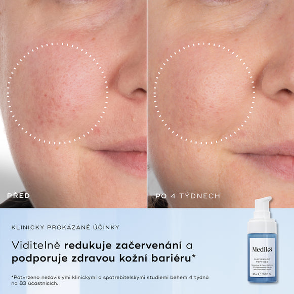 Rozdělený obrázek zobrazuje detailní záběr textury pleti označený „Před“ a „Po 4 týdnech“, který zdůrazňuje viditelné zlepšení.Text vlevo uvádí následující benefity:
Redukce nedokonalostí pleti
Zlepšení textury pleti
Zmenšení viditelnosti pórů
Zklidnění viditelného zarudnutí-hover-11