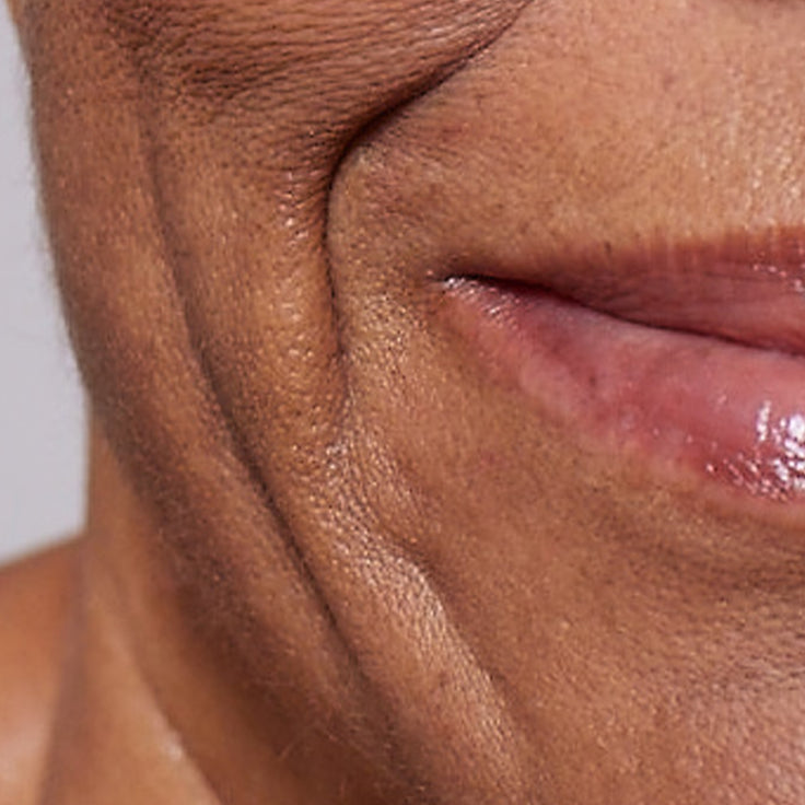 Detailní záběr (makrofotografie) zobrazující viditelný nedostatek pevnosti a elasticity pleti kolem úst a čelisti osoby. Pod obrázkem je jasný text, který tento kožní problém označuje jako „Pevnost“.